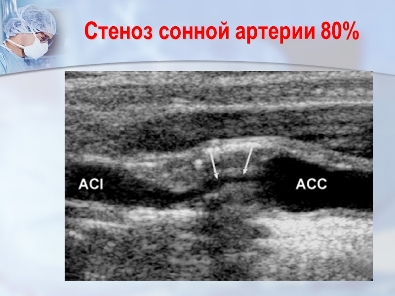 Стеноз сонной артерии 80%